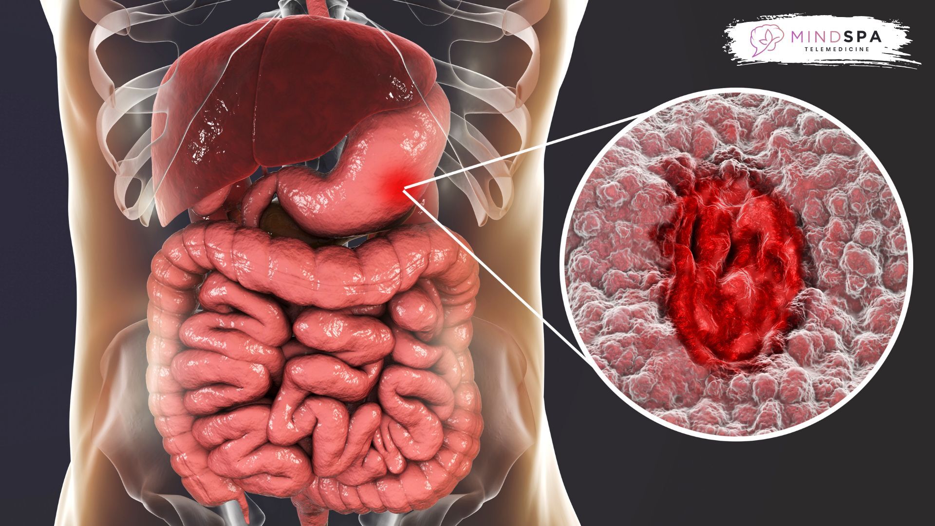 cortisol on stomach discomfort caused by anxiety