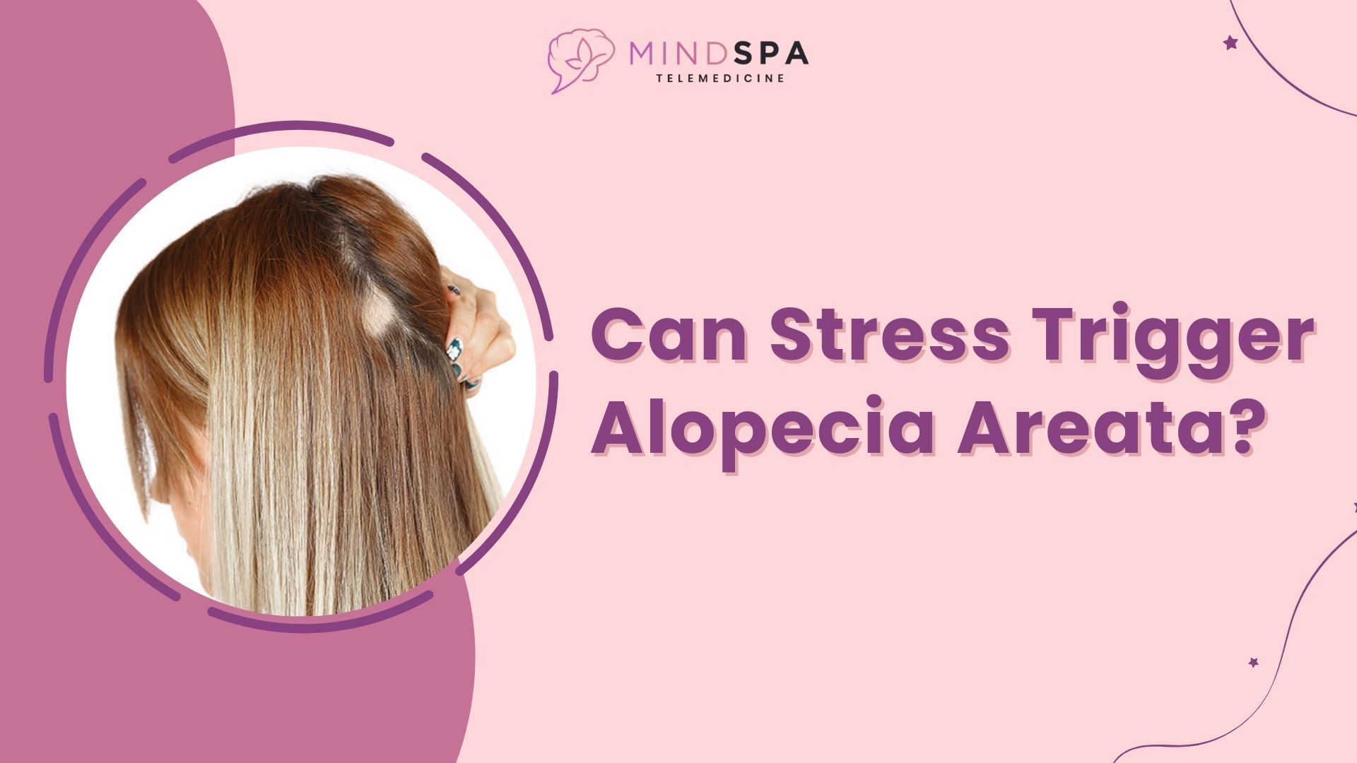 Can Stress Trigger Alopecia Areata